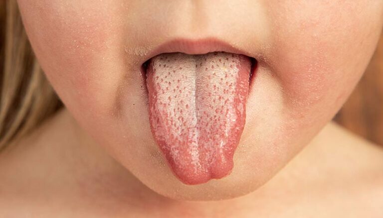 Скарлатина